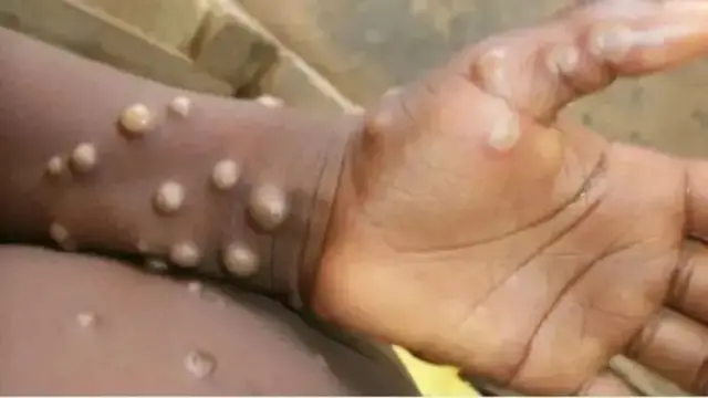 A new global health emergency: All you need to know about mpox outbreak