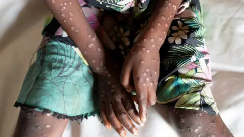 A new global health emergency: All you need to know about mpox outbreak